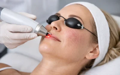 Laser Treatment for Broken Capillaries
